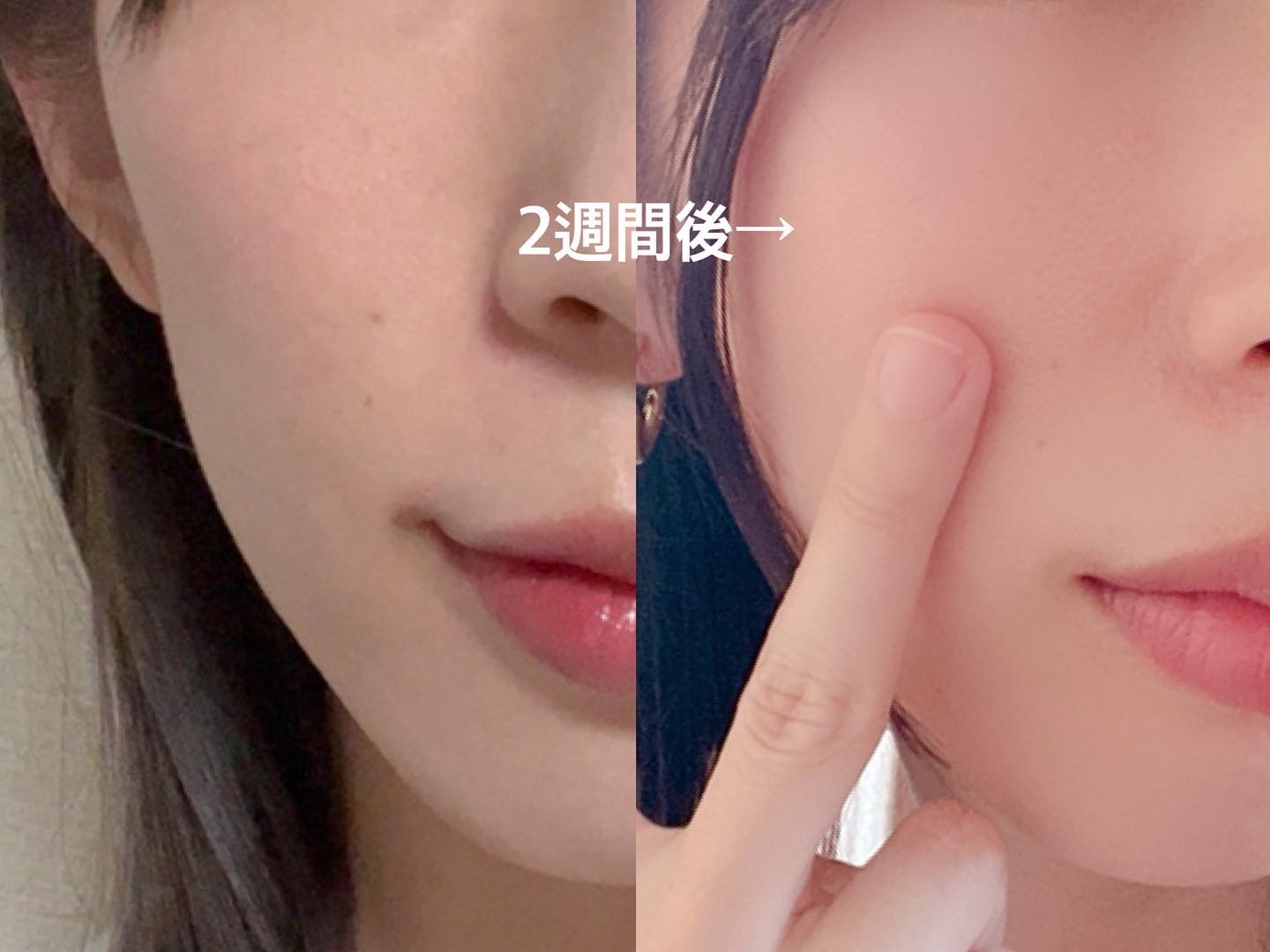 リードルショット100/VT/美容液を使ったクチコミ（3枚目）