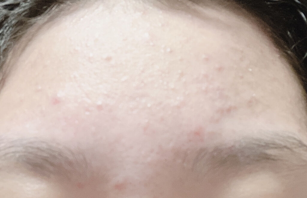 ロゼット洗顔パスタ アクネクリア/ロゼット/洗顔フォームを使ったクチコミ（2枚目）