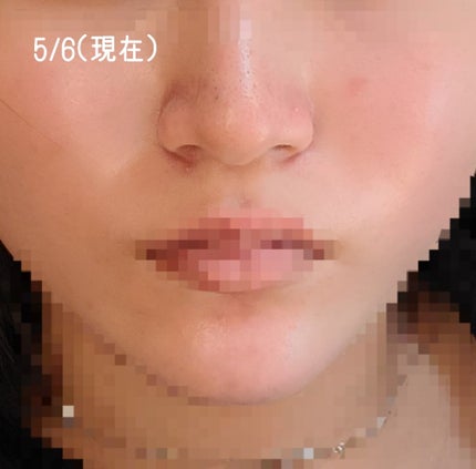 umi on LIPS 「"ニキビ肌女子の肌経過"自分の肌を投稿するのはとても迷いました..」(5枚目)