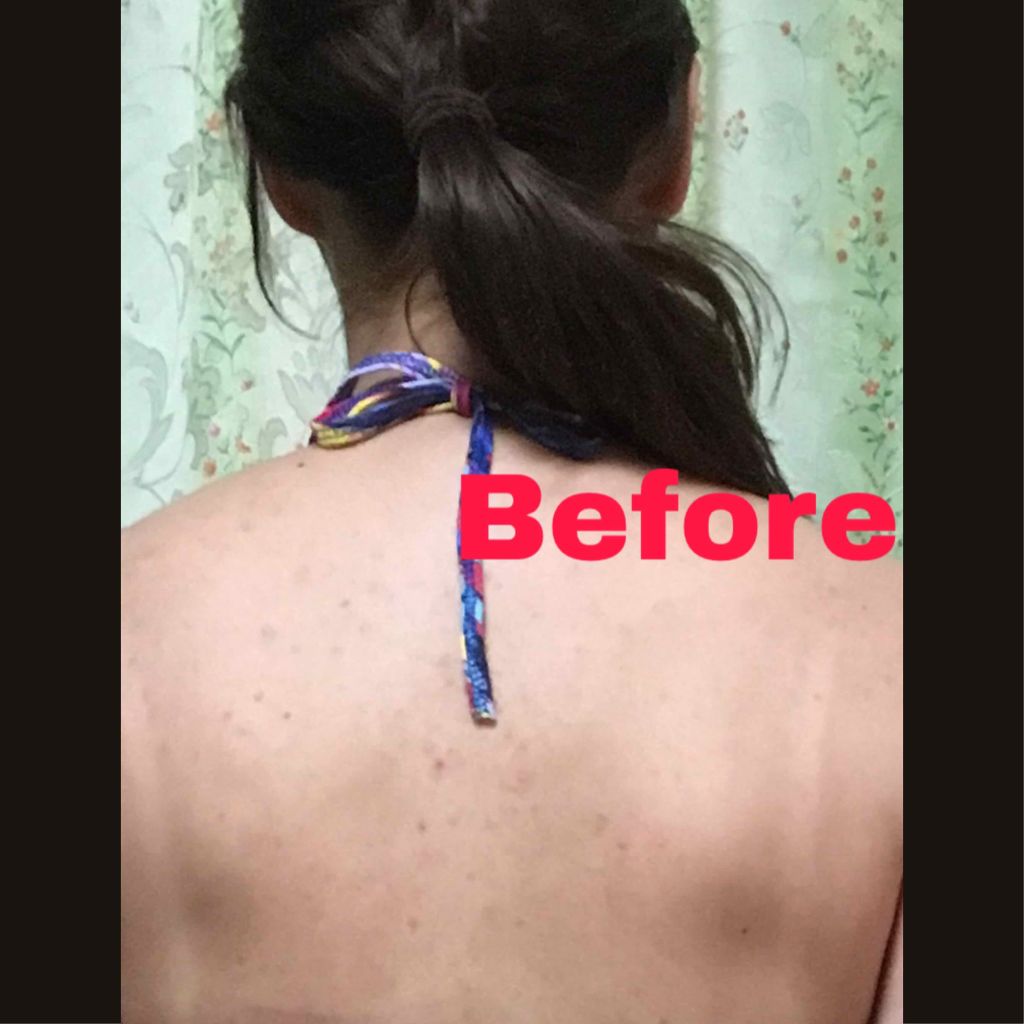 ちでじ on LIPS 「【ニキビ・ニキビ跡治療について】20歳から背中・デコルテニキビ..」(2枚目)