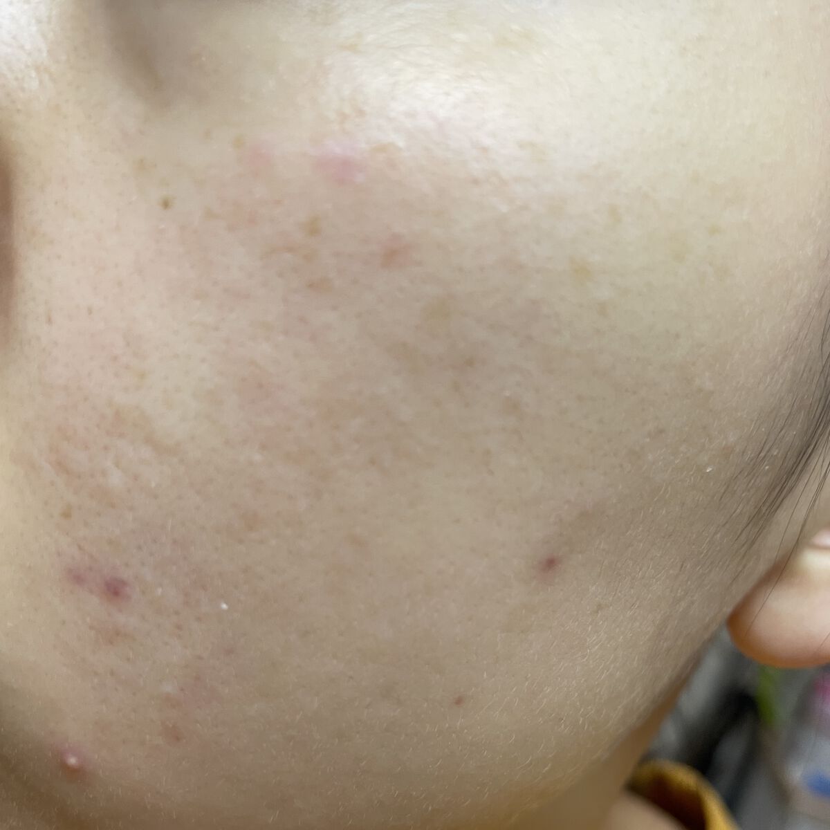 薬用 しみ 集中対策 美容液/メラノCC/美容液を使ったクチコミ（2枚目）