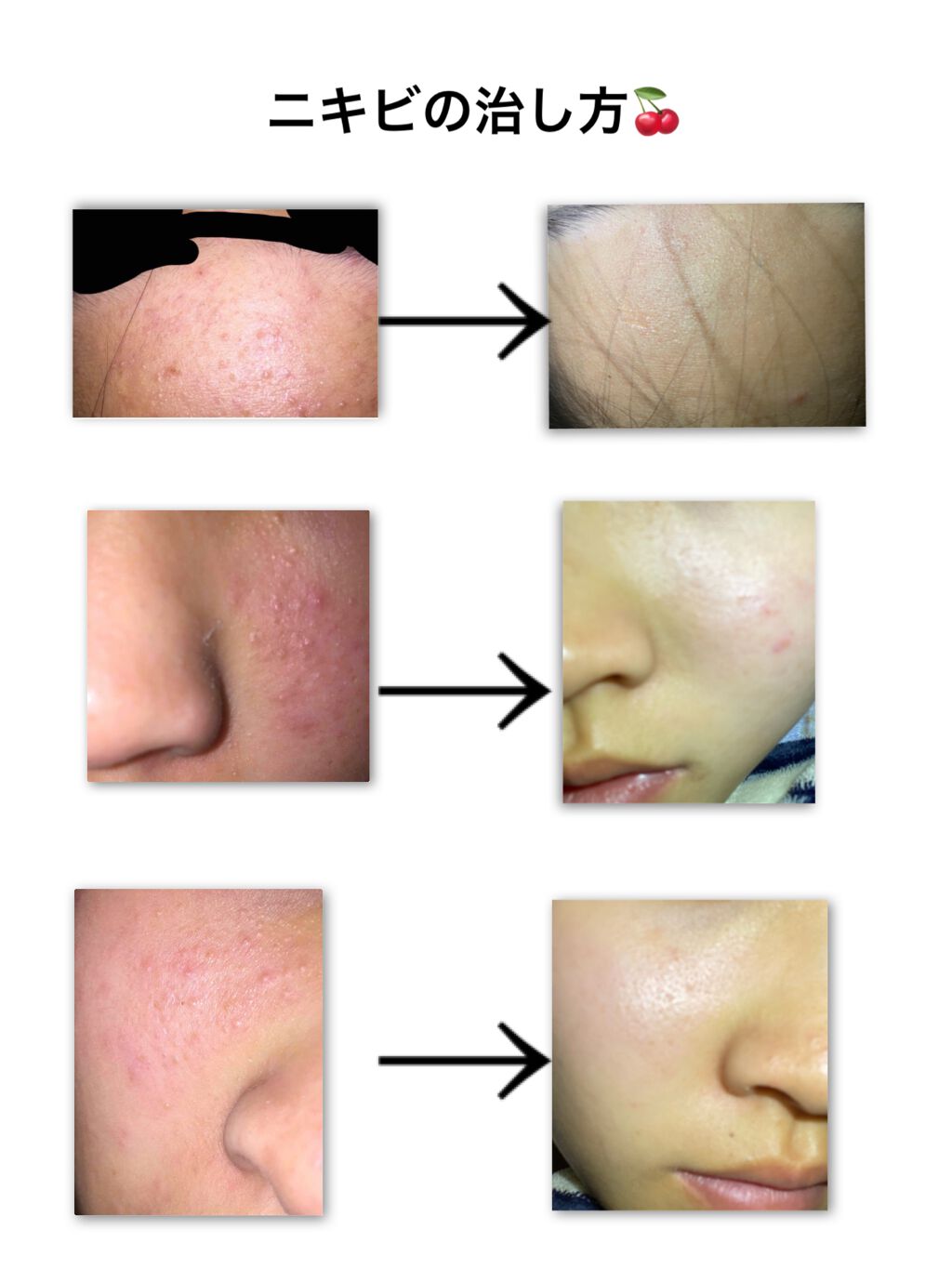 薬用 しみ 集中対策 美容液/メラノCC/美容液を使ったクチコミ（1枚目）