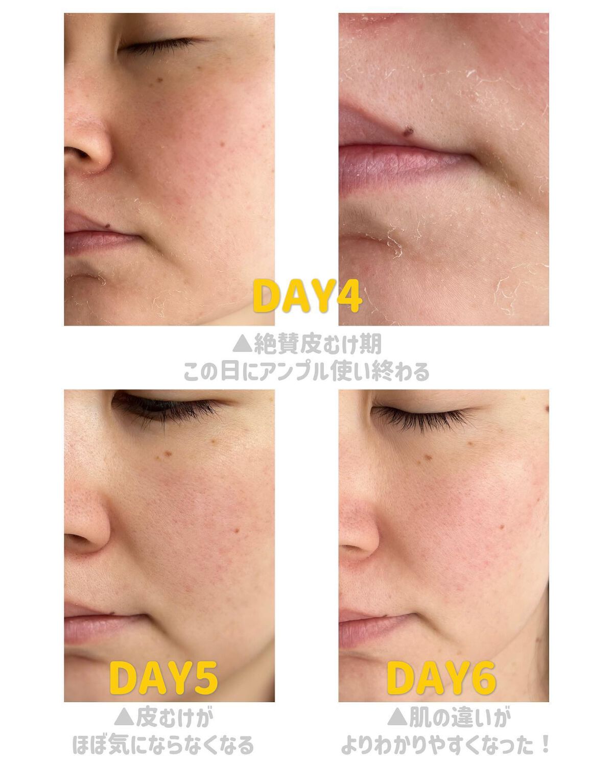 ダーマスキンピーリング/BQCELL/その他キットセットを使ったクチコミ(6枚目)