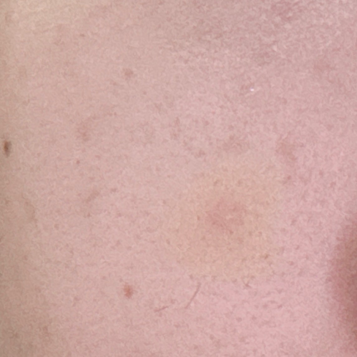 薬用コンシーラー アクネプロテクター/ONLY MINERALS/パウダーコンシーラーを使ったクチコミ(5枚目)