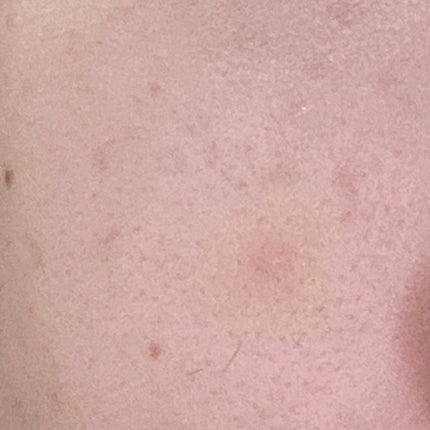 薬用コンシーラー アクネプロテクター/ONLY MINERALS/パウダーコンシーラーを使ったクチコミ(5枚目)