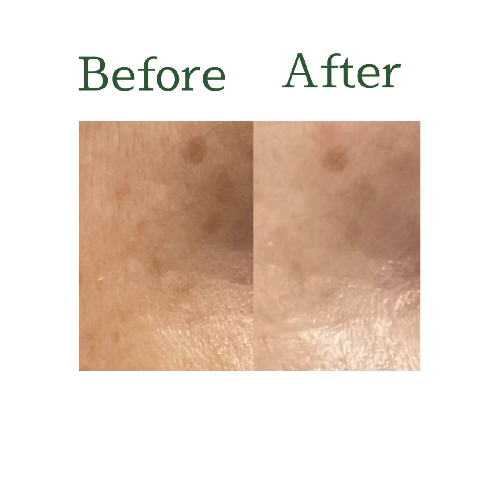 リードルショット300/VT/美容液を使ったクチコミ（3枚目）