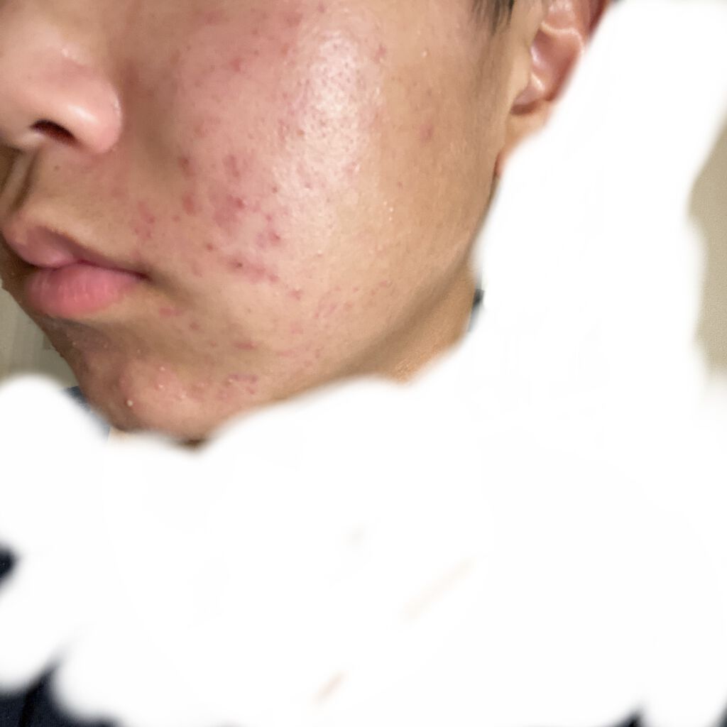 グリーンダーマCICAセラム/ネイチャーリパブリック/美容液を使ったクチコミ（1枚目）