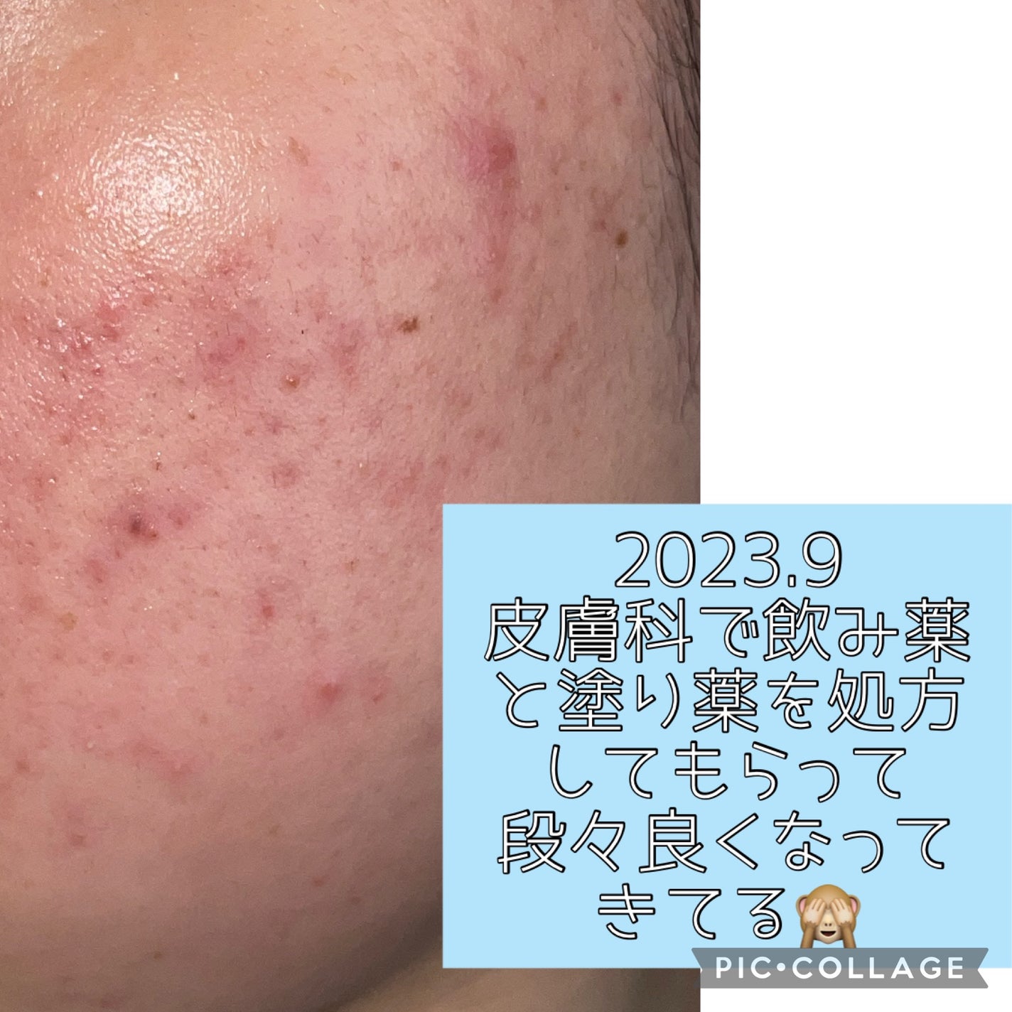 ニキビ治療薬(医薬品)/メンソレータム アクネス/その他を使ったクチコミ(5枚目)