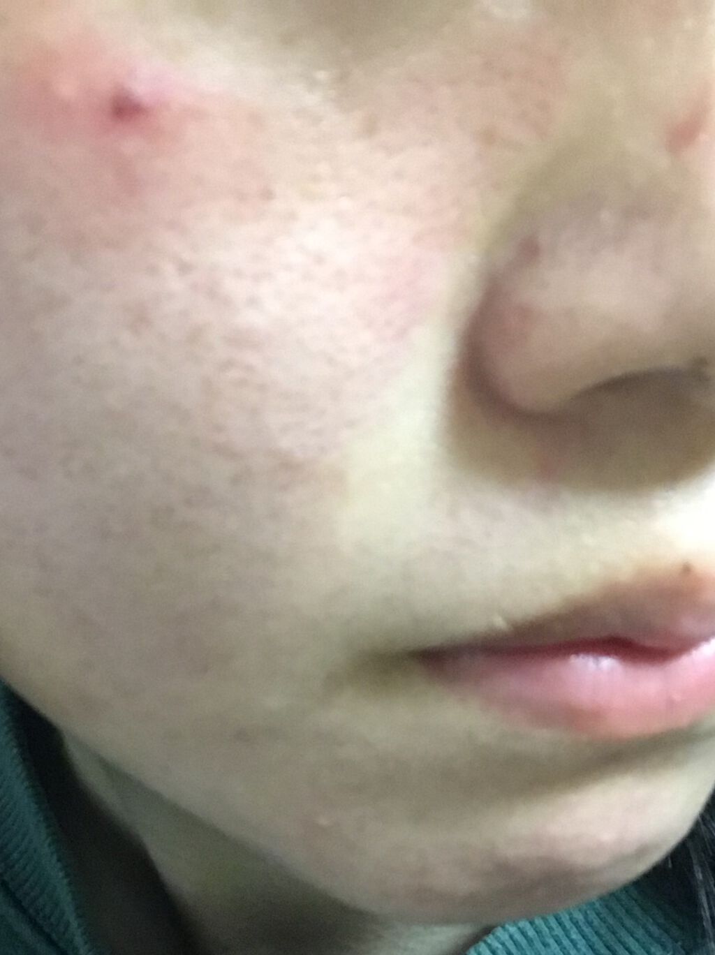 エピデュオゲル/マルホ株式会社/その他を使ったクチコミ（1枚目）