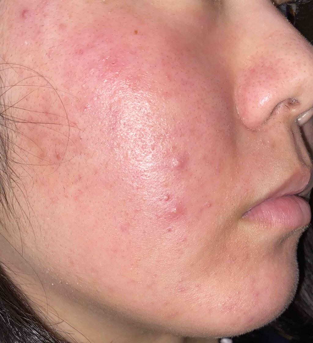 ぴろ on LIPS 「ニキビ撲滅日記6日目🔥5/30(遅れてすみません)なんか昨日よ..」(2枚目)