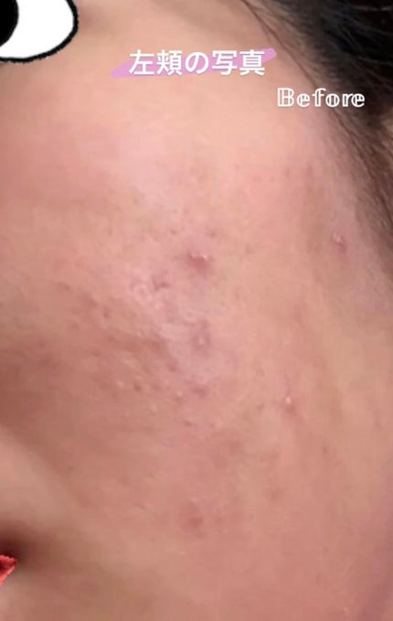 薬用 しみ 集中対策 美容液/メラノCC/美容液を使ったクチコミ(5枚目)