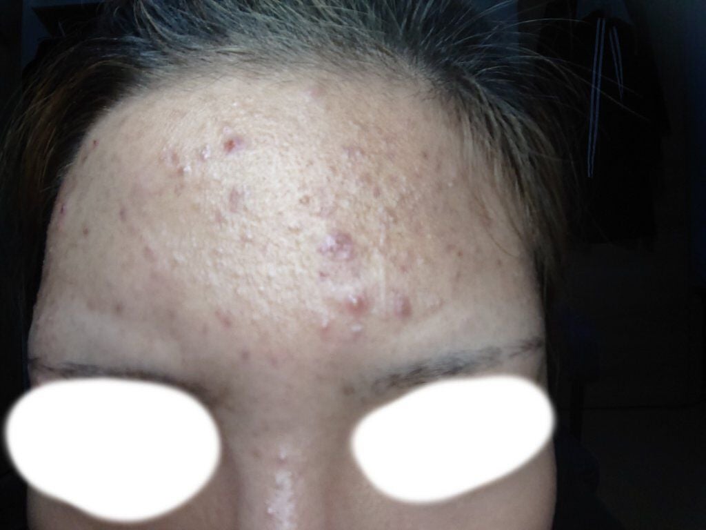 ゆう on LIPS 「小学校の時からニキビに悩んでいます。色々試しましたがあまり効果..」(2枚目)