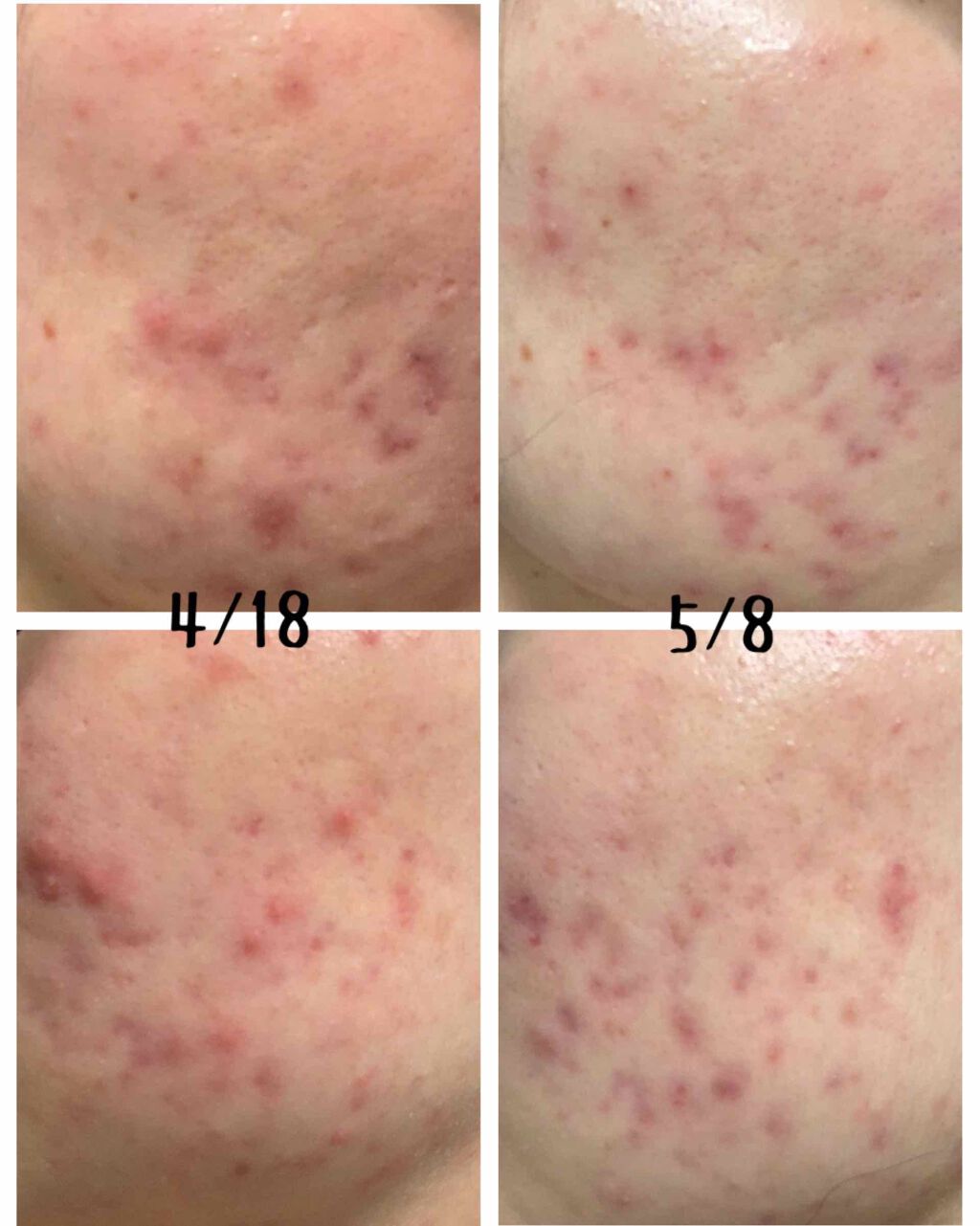 薬用アクネコントロール スポッツエッセンス EX/DHC/美容液を使ったクチコミ（2枚目）