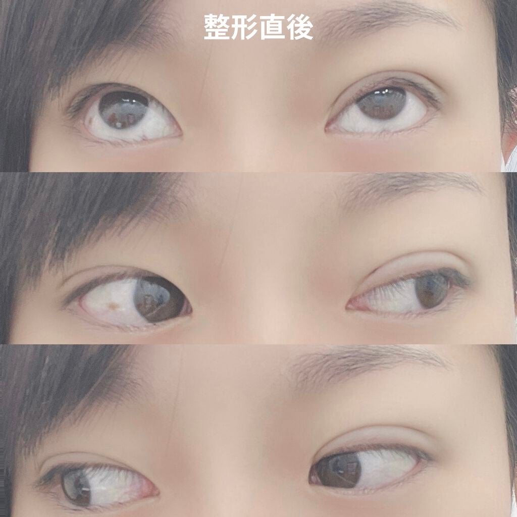 なつ on LIPS 「二重整形(埋没)しました整形記録1閲覧注意2日目〜 右目眼球内..」(2枚目)