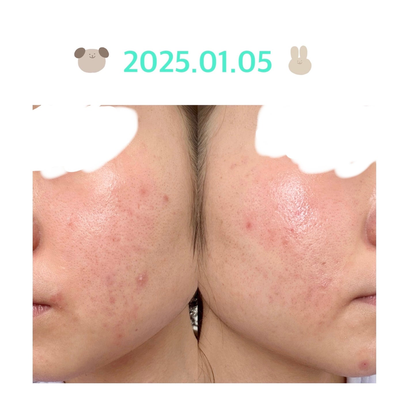 colorful_sounds_rgn on LIPS 「ニキビ経過1日目最近ニキビが爆誕し始めて人と会うのも嫌になるく..」(1枚目)