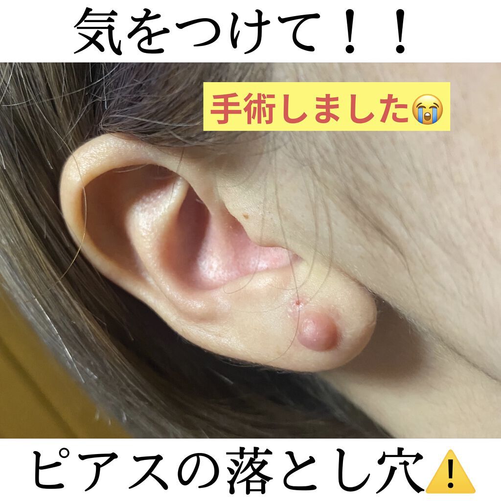 こんばんは〜！！

遅くなりましたが、あけましておめでとうございます🎍⛩
今年もよろしくお願い致します🤲


さて、年末に手術をしてきました😂

どこを手術したかというと、、、
耳たぶです！！

長くなりますが、皆様に同じ思いをして欲