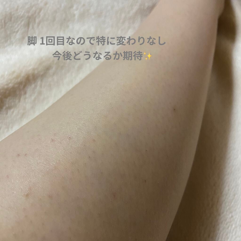 光脱毛器 VIO/Sarlisi/家庭用脱毛器を使ったクチコミ(3枚目)