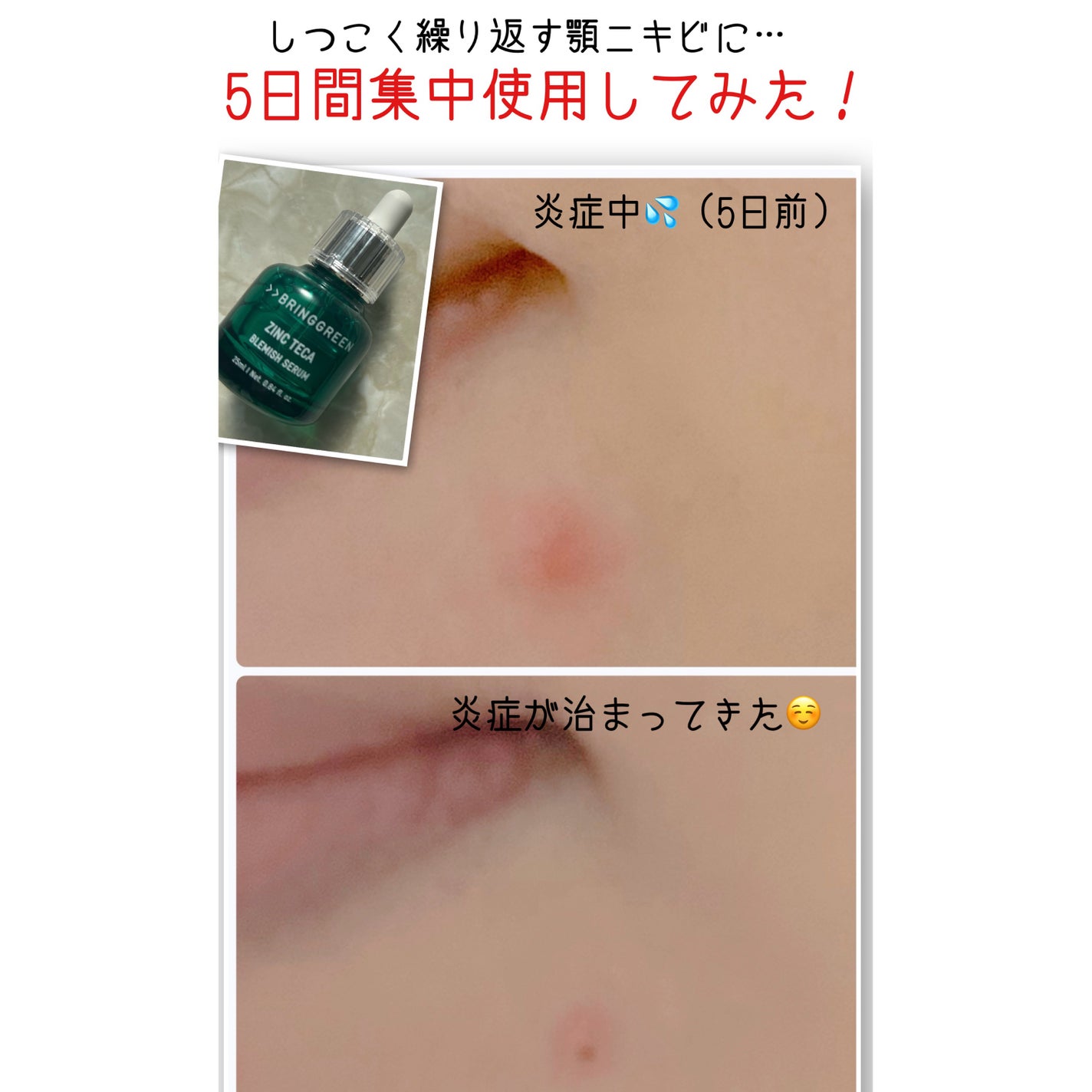 ジンクテカBセラム/BRING GREEN/美容液を使ったクチコミ(5枚目)