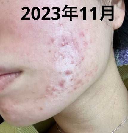 乾燥さん 薬用しっとり化粧液【医薬部外品】/乾燥さん/オールインワン化粧品を使ったクチコミ(1枚目)