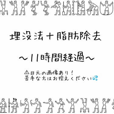 こんにちは、殴られたガチャピンです🐣
昨夜埋没法と脂肪除去を行いました。
記録がてら二重整形を考えている方の参考になればと思い投稿しております☡🖋

不慣れですがよろしくお願いします🌝

朝になりました