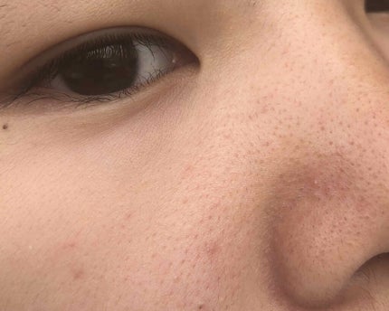 coral_cosme_66bp on LIPS 「中学2年の女子です。小学6年生の頃から鼻のブツブツに悩んでいた..」(2枚目)