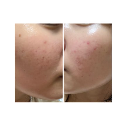 ぽむ on LIPS 「2023.9.13皮膚科に受診 エピデュオとヘパリン処方1枚目..」(4枚目)