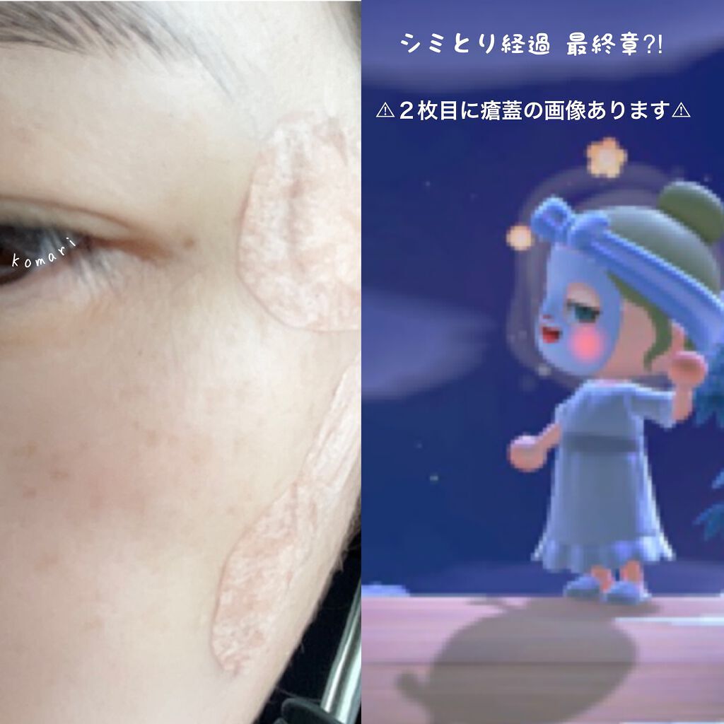 小鞠 on LIPS 「⌘シミとり経過記録最終章⚠︎画像2枚目に取れた瘡蓋の画像ありま..」(1枚目)