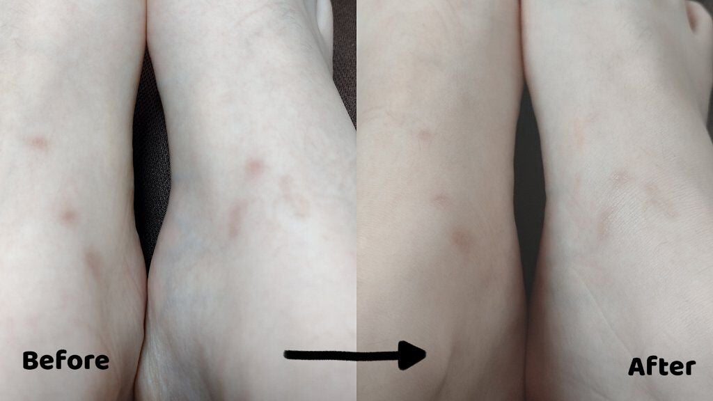 アットノンEX クリーム(医薬品)/アットノン/その他を使ったクチコミ(2枚目)