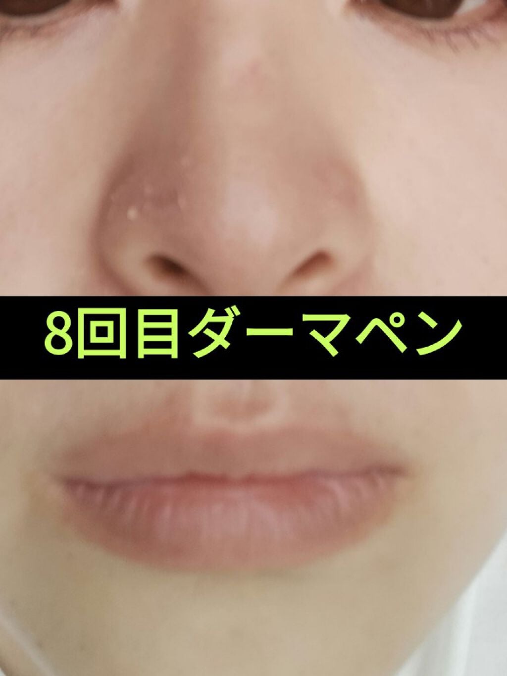 ダーマペン・ダーマスタンプ/MyM/その他スキンケアグッズを使ったクチコミ(1枚目)