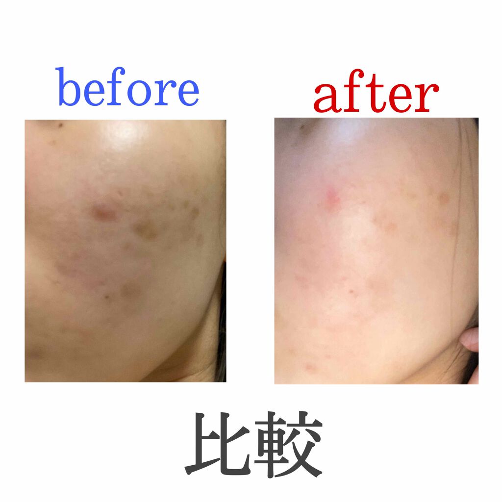 薬用しみ対策 美白化粧水 しっとりタイプ/メラノCC/化粧水を使ったクチコミ（2枚目）