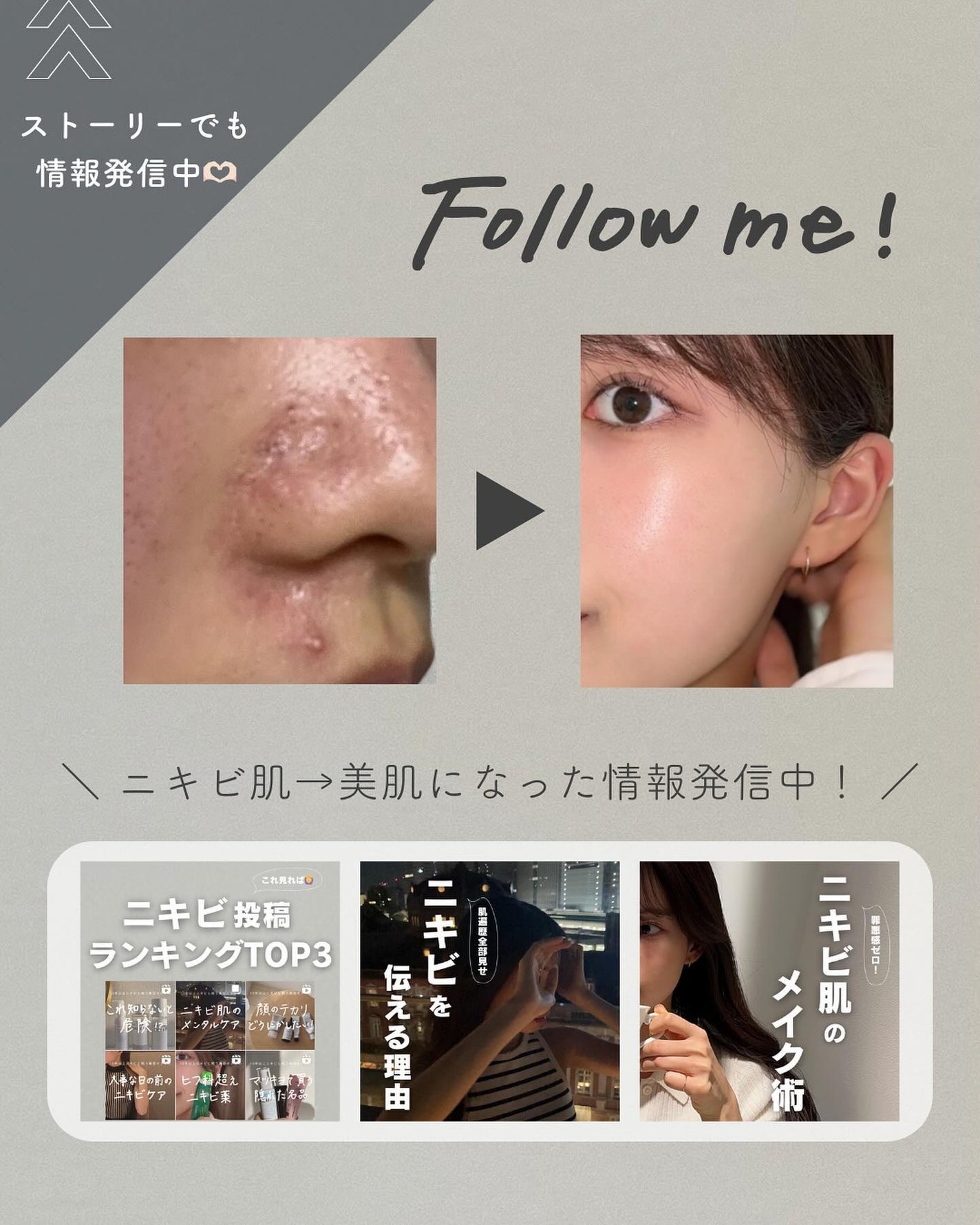 白湯(サユ) | ニキビと戦うOL🤍 on LIPS 「これ見ればOK!ニキビ改善の教科書📕ニキビって一括りにされる..」(8枚目)