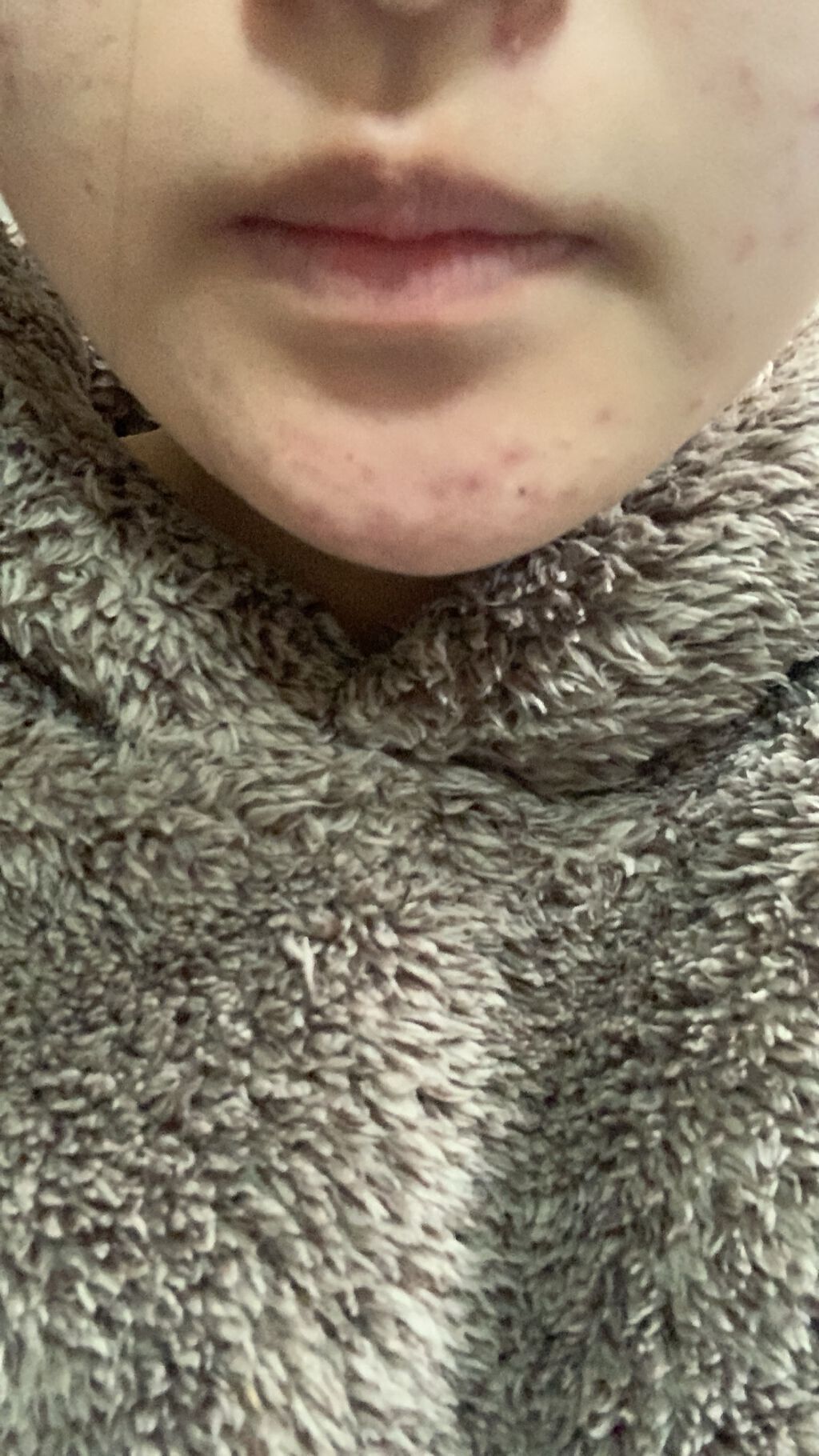 ピ on LIPS 「ニキビ&ニキビ跡改善日記2日目📖昨日よりニキビが増えてしまいま..」(4枚目)