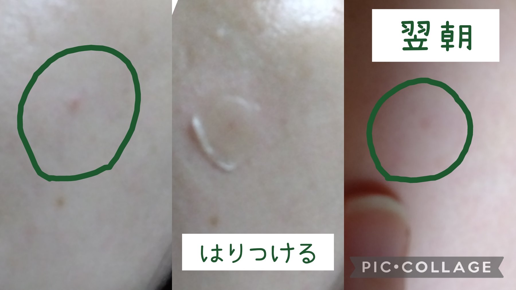 プロCICA クリアスポットパッチ/VT/その他スキンケアを使ったクチコミ（2枚目）