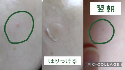 プロCICA クリアスポットパッチ/VT/その他スキンケアを使ったクチコミ(2枚目)
