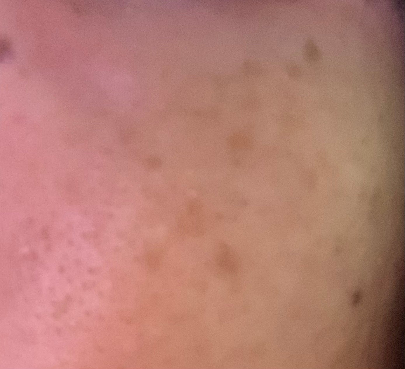 らん♥コスメ、シミケア観察 on LIPS 「頬のシミ取りを皮膚科で相談したところ肝斑とシミが混じっているの..」(2枚目)