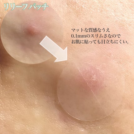 ビューティー スポットパッチ/イージーダムビューティー/にきびパッチを使ったクチコミ(5枚目)