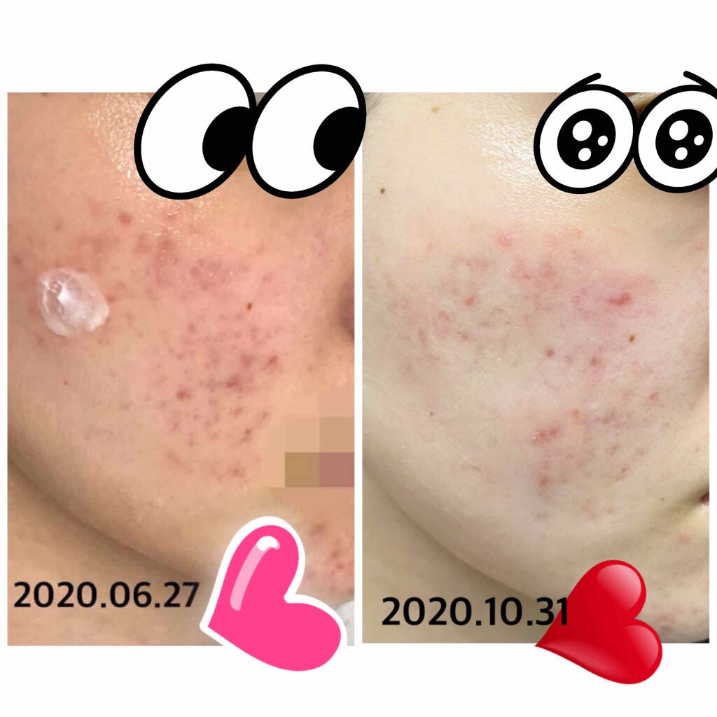 メロサカ on LIPS 「6月から10月までの頬ニキビ跡の推移。いろいろやってきて、ニキ..」(1枚目)