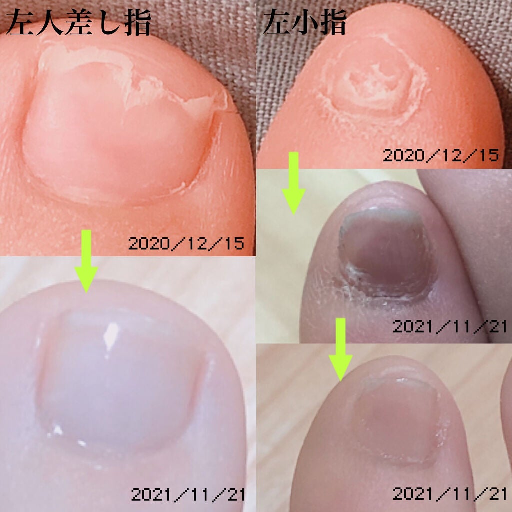 ネイルエンビー/O・P・I/ネイルオイル・トリートメントを使ったクチコミ(4枚目)