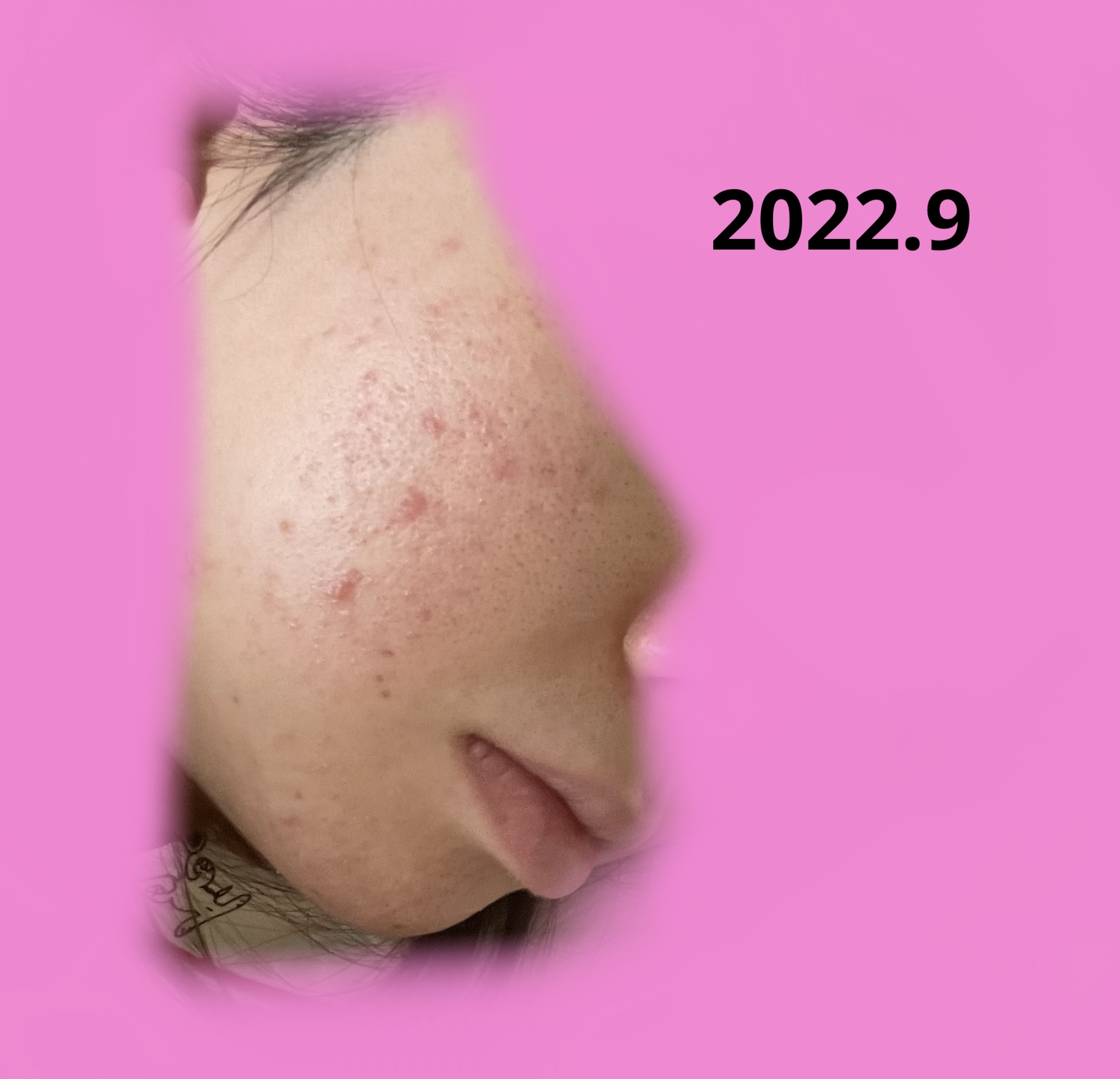 ジョンソン ベビーオイル 無香料/ジョンソンベビー/ボディオイルを使ったクチコミ（2枚目）