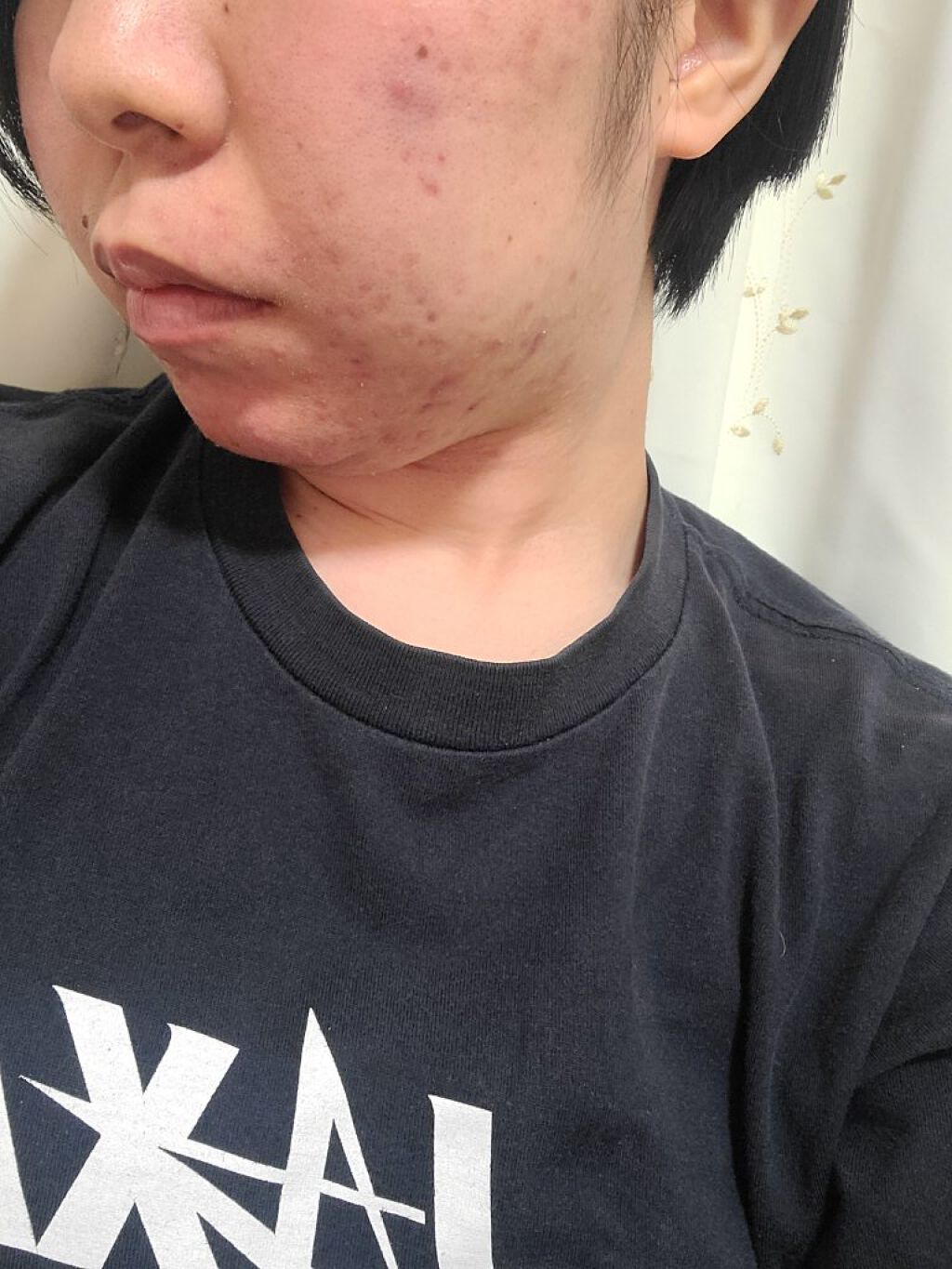 Ａ アクネジェル/NOV/美容液を使ったクチコミ（3枚目）