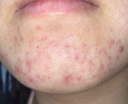 ぴろ on LIPS 「ニキビ撲滅日記を5/25~始めました🔥25日に始めようとしたん..」(4枚目)