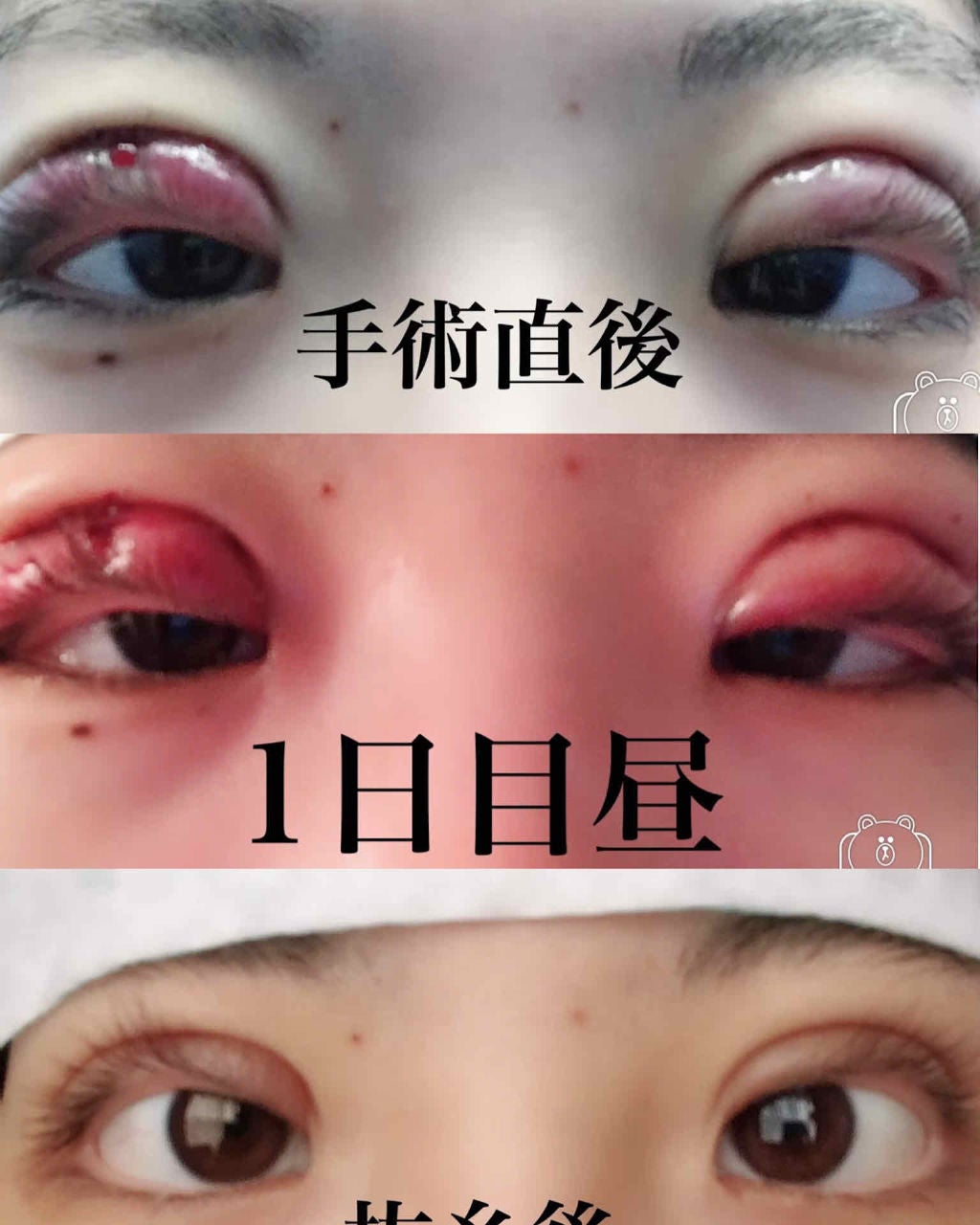 さほ on LIPS 「注意!!目のアップの画像、2枚目に整形直後(切開)の腫れた目の..」(2枚目)