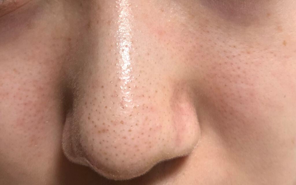 ぷー on LIPS 「【助けてください!!】現在高校2年生です。中学の時から毛穴ひど..」(2枚目)