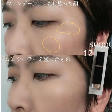 SUQQU インテンス カバー コンシーラーのクチコミ「
✔️SUQQUは白っぽい色味ですがシミがこれ一本で隠れます。ただし、シミのところにもう一回.....」(2枚目)