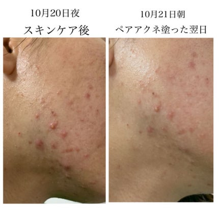 ペアアクネクリームW(医薬品)/ペア/その他を使ったクチコミ(4枚目)