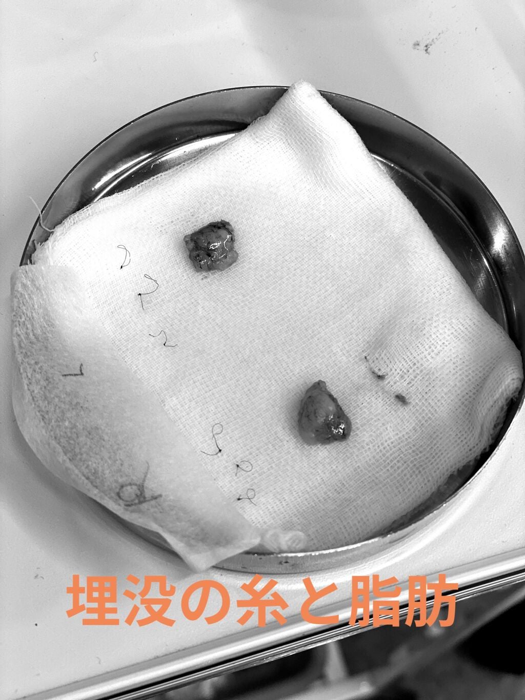 め@フォロバします on LIPS 「6/21追記二重全切開&脱脂の記録。2021年8月31日に受け..」(3枚目)