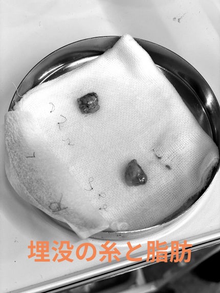 二重整形/その他を使ったクチコミ(3枚目)