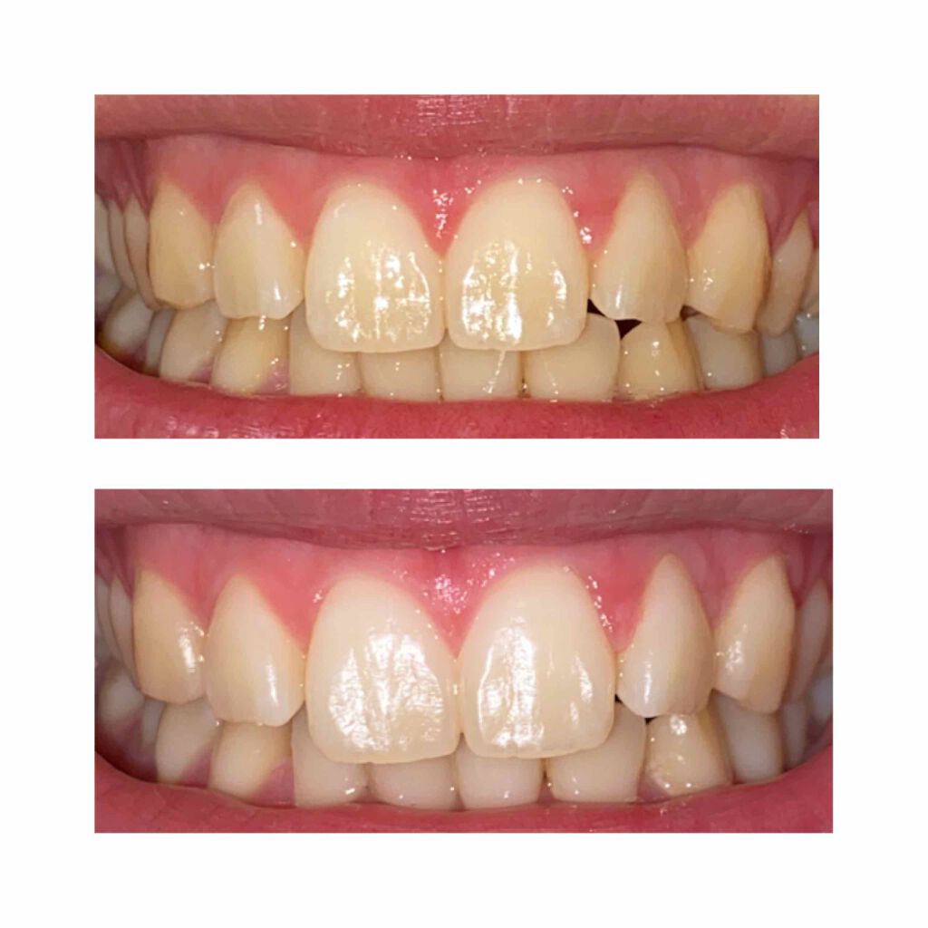 Crest SUPREME whitestrips /Crest/その他オーラルケアを使ったクチコミ(2枚目)