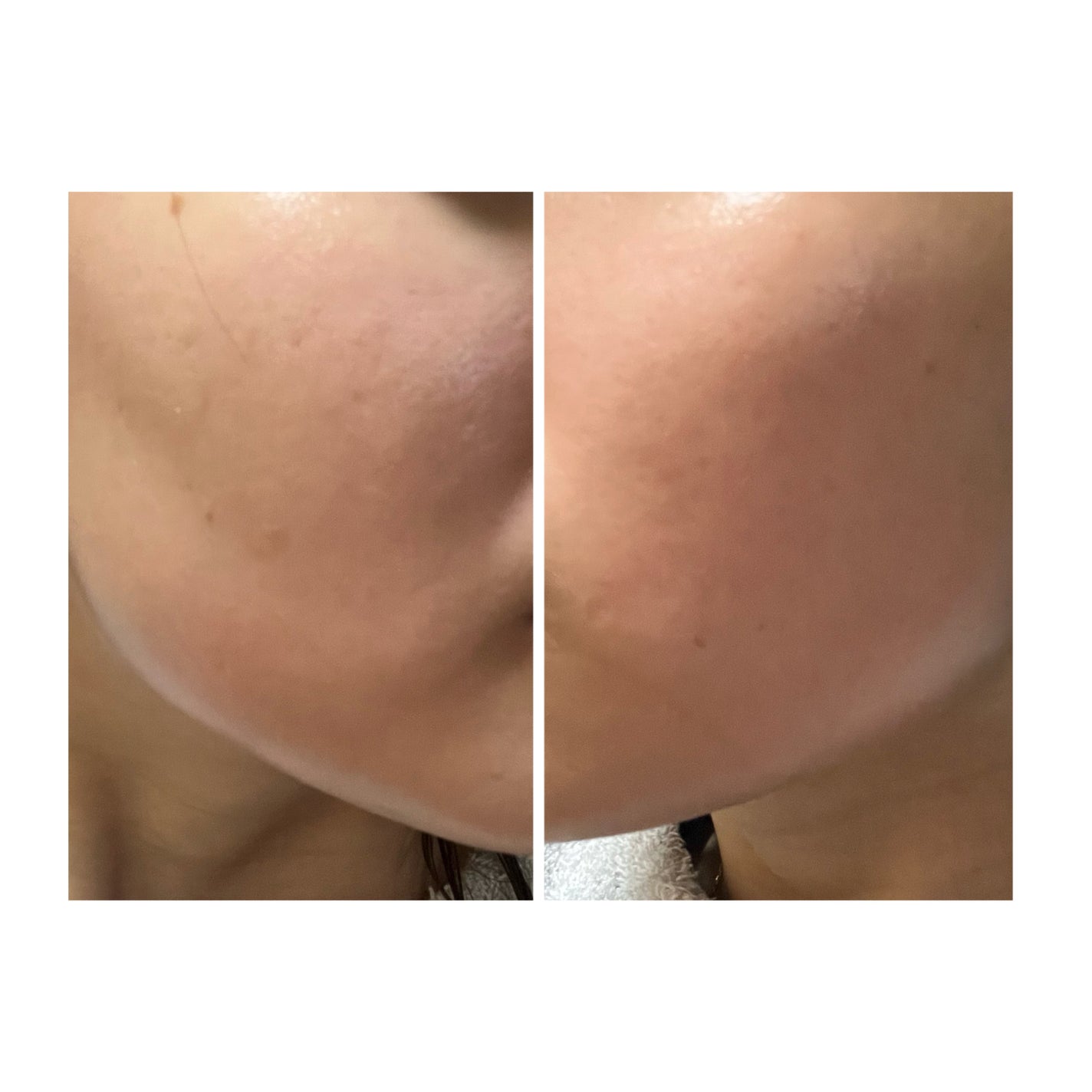 ぽむ on LIPS 「2023.9.13皮膚科に受診 エピデュオとヘパリン処方1枚目..」(3枚目)