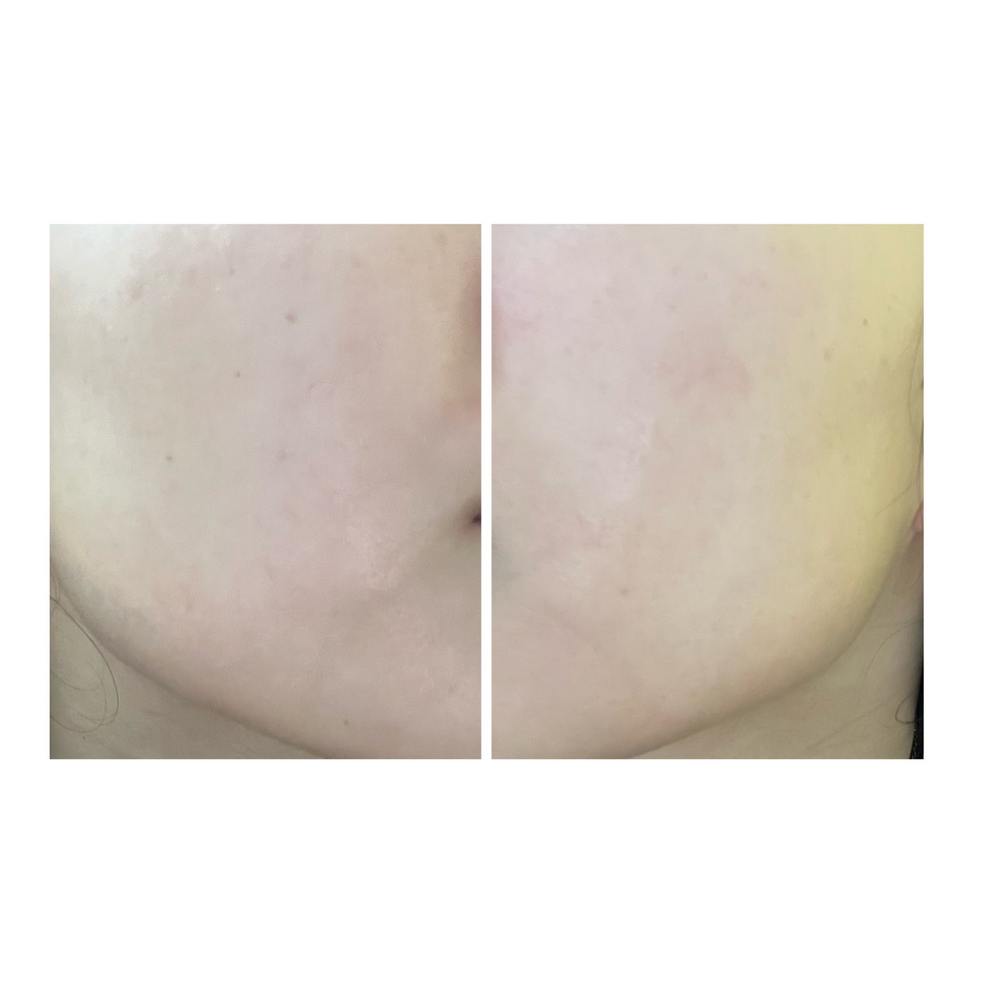 ぽむ on LIPS 「2023.9.13皮膚科に受診 エピデュオとヘパリン処方1枚目..」(2枚目)